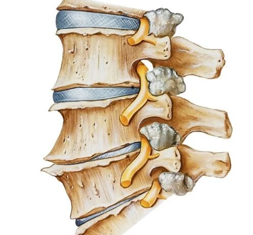 Pinching ti nafu ni ọpa ẹhin