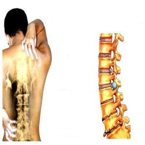 Awọn ipele ti osteochondrosis