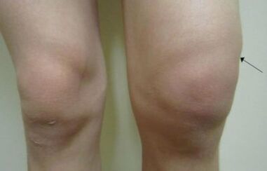 Awọn ifihan ile-iwosan ti arthrosis ti orokun orokun