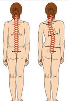 Scoliosis