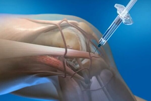 Awọn abẹrẹ Intra -artucular fun Arthrosis ti apapọ orokun