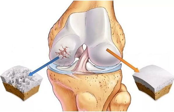 Carbilige ti o ni ilera ati frefelibage fowo nipasẹ arthrosis