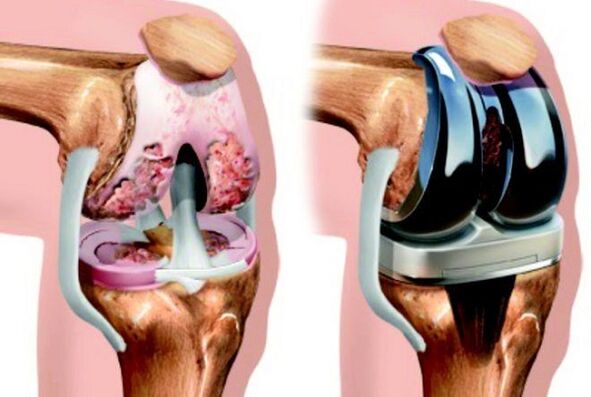 Ṣaaju ki o to lẹhin decoprosthetics ti apapọ orokun pẹlu arthrosis