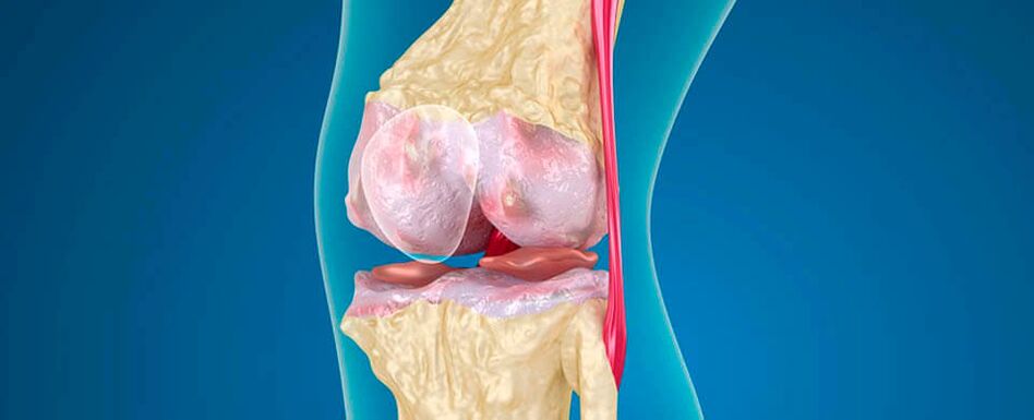 arthrosis ti isẹpo orokun